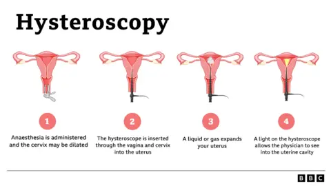 Graphic describing the hysteroscopy process